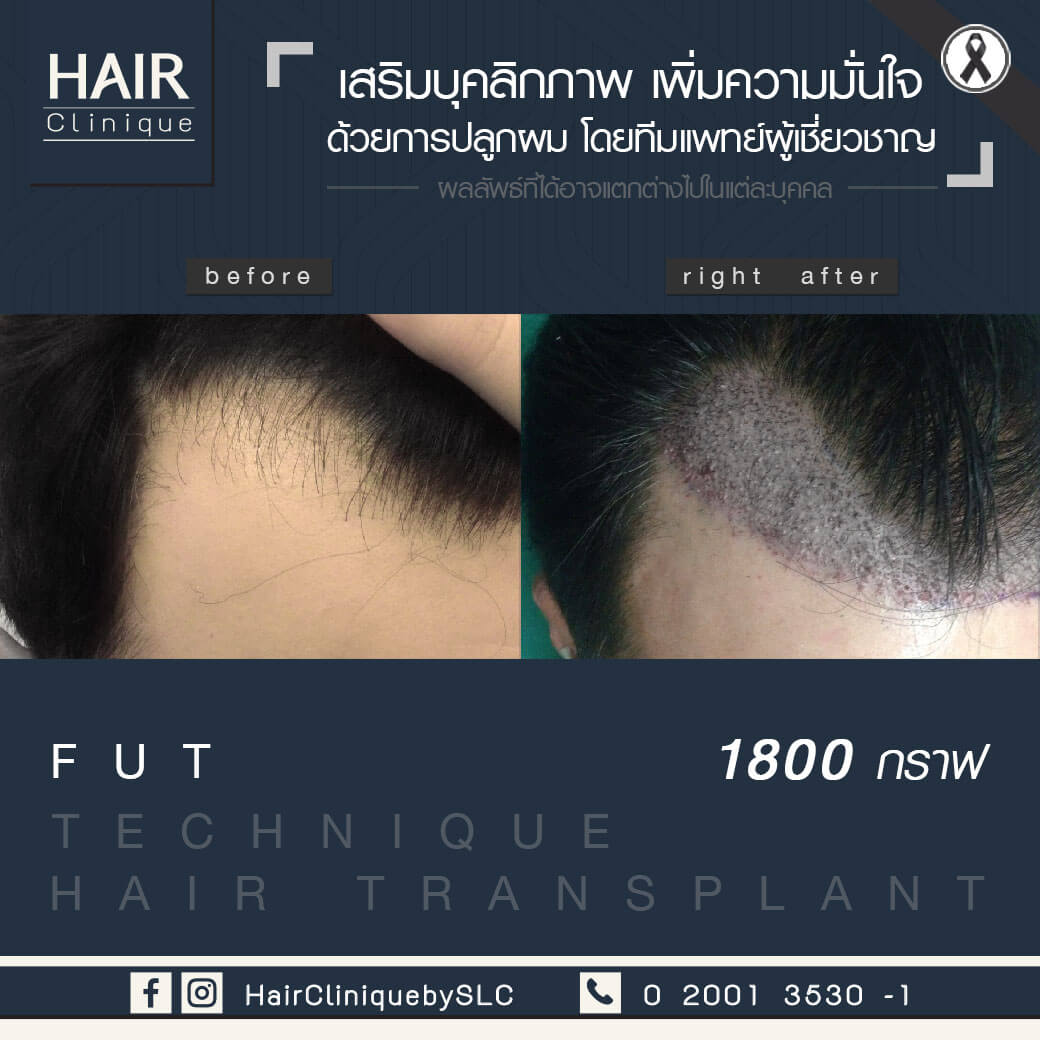 ปลูกผม-ปลูกผม fut-รีวิวปลูกผม fut-รีวิวปลูกผม