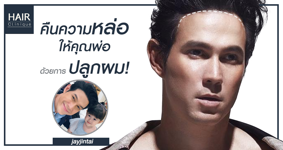 คืนความหล่อ ให้คุณพ่อด้วยการปลูกผม !