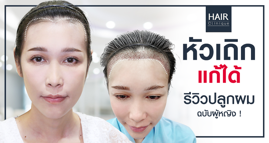 รีวิวปลูกผมผู้หญิง แก้ปัญหาหัวเถิกผมบาง!