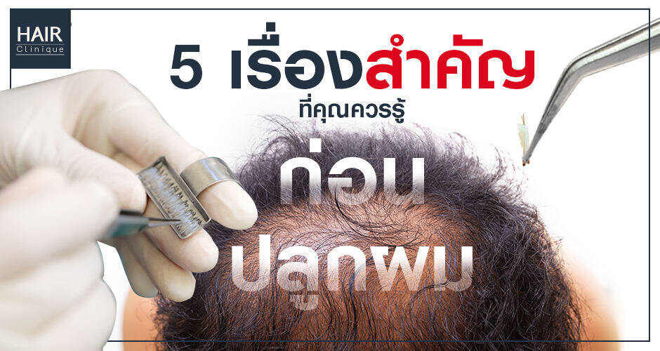 5 เรื่องสำคัญที่คุณควรรู้ ก่อนปลูกผม