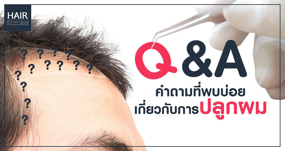 Q&A คำถามที่พบบ่อย เกี่ยวกับการปลูกผม