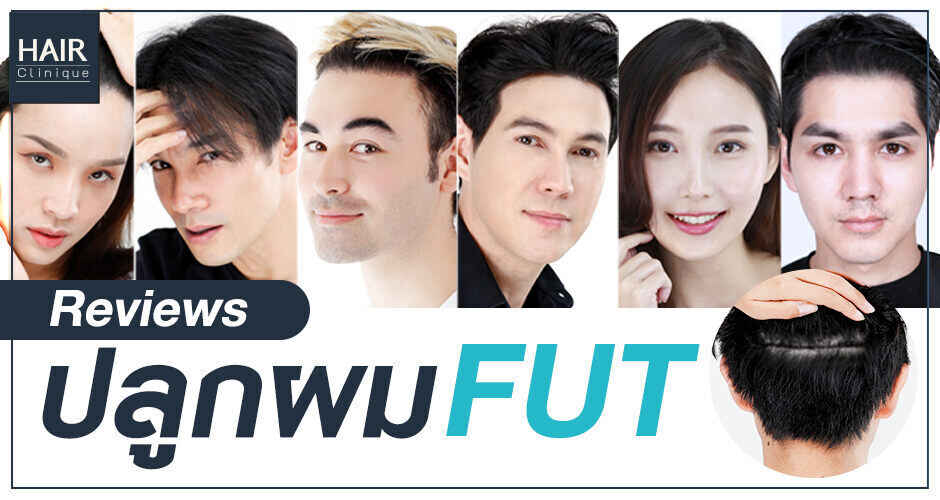 รีวิวสุดปังของคนดังที่เทใจ ปลูกผม FUT ที่ Hair Clinique