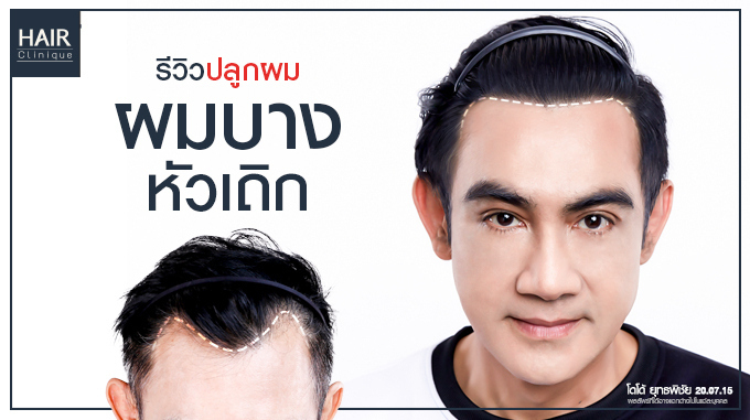 รีวิวปลูกผม ผมบาง หัวเถิก