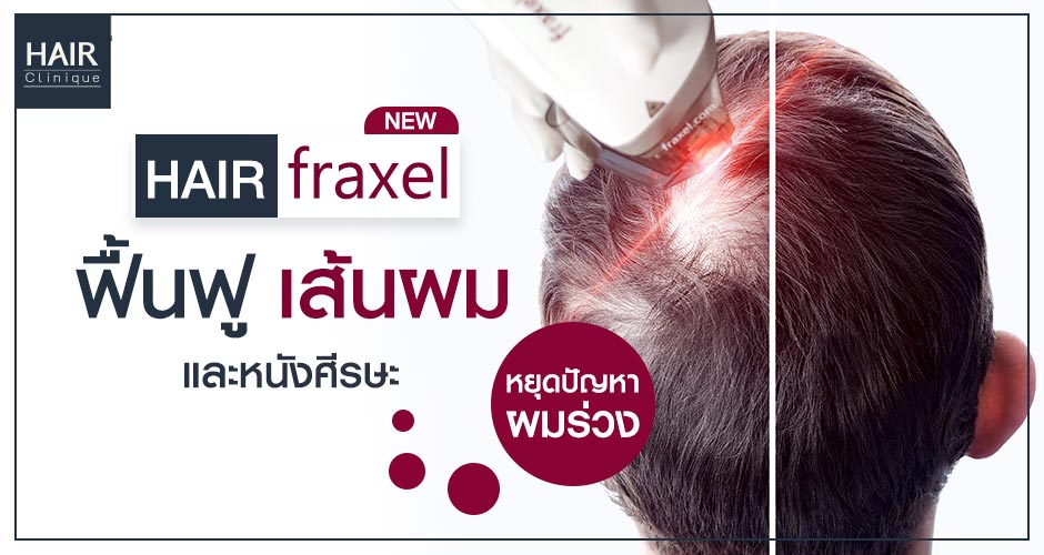 Hair Fraxel เลเซอร์กระตุ้นรากผม ฟื้นฟูผมร่วง