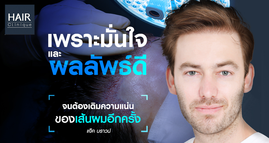 ปลูกผม 2 รอบ ผลลัพธ์ดี! จนต้องเติมความแน่นอีกครั้ง