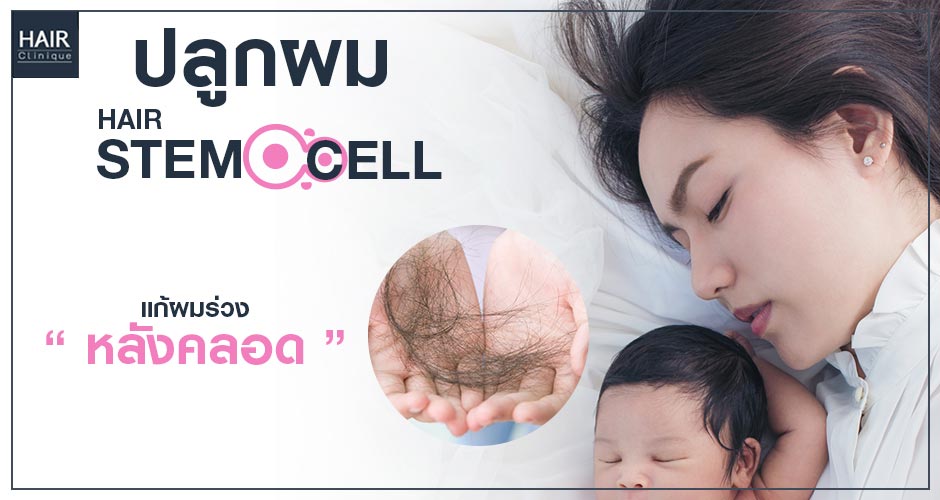 ปลูกผม Stem Cell แก้ผมร่วงหลังคลอด