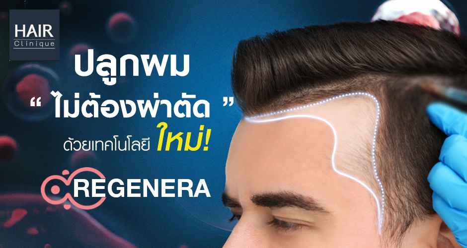 Regenera Activa ปลูกผมไม่ต้องผ่าตัด