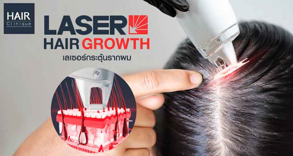 Laser Hair Growth เลเซอร์กระตุ้นรากผม สร้างผมใหม่ ลดผมบาง