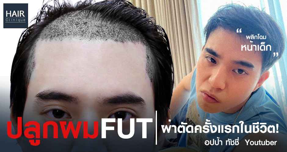 ปลูกผม FUT ผ่าตัดครั้งแรกในชีวิต! พลิกโฉมหน้าเด็ก