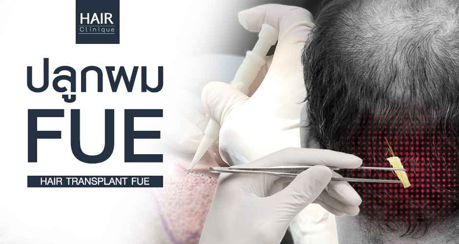 Hair Transplant FUE (Follicular Unit Extraction)