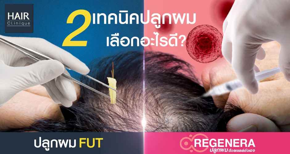 2 เทคนิคปลูกผม เลือกอะไรดี? ปลูกผม FUT vs ปลูกผม Regenera activa