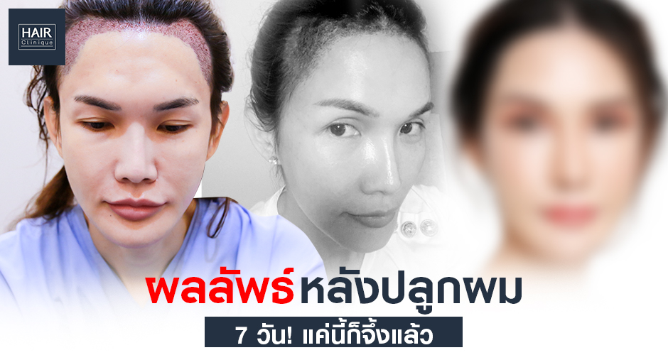 ผลลัพธ์หลังปลูกผม 7 วัน! แค่นี้ก็จึ้งแล้ว