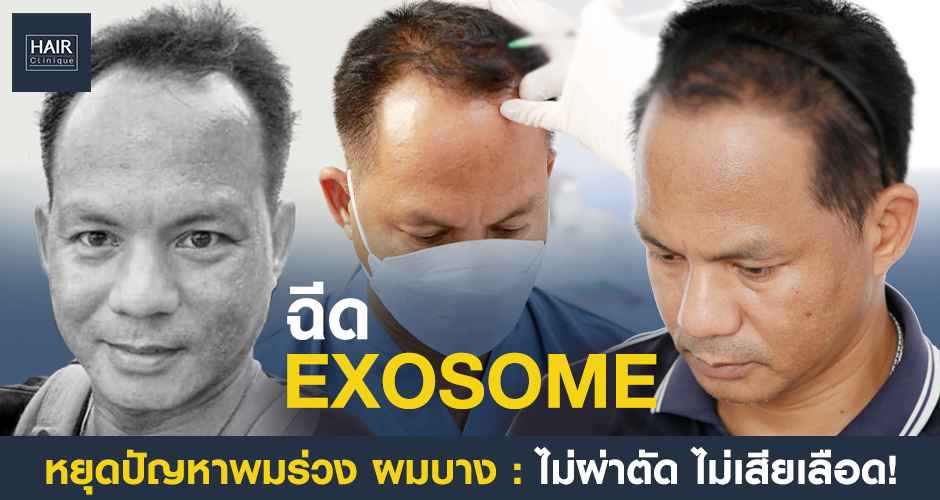 รีวิวฉีด Exosome ย้อนวัยเส้นผม แก้ปัญหาผมร่วง ผมบาง