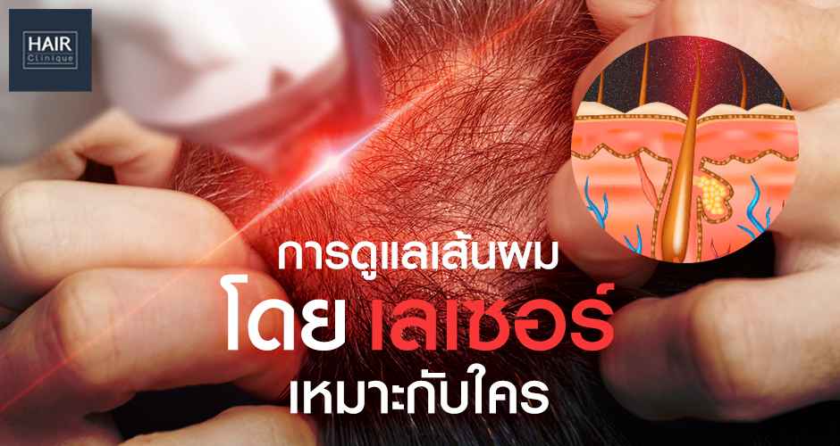 การดูแลเส้นผมโดยเลเซอร์ผมเหมาะกับใคร?