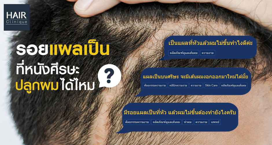 ตอบ Pantip! รอยแผลเป็นบนหนังศีรษะ ปลูกผมได้ไหม?