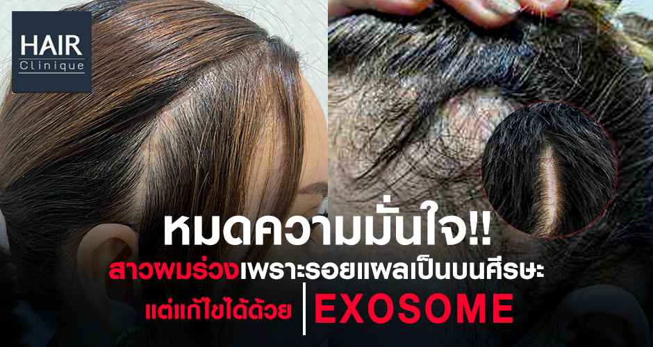 หมดความมั่นใจ!! สาวผมร่วงเพราะรอยแผลเป็นบนศีรษะ แต่แก้ไขได้ด้วย Exosome