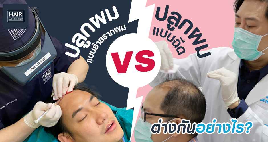 ปลูกผมแบบย้ายรากผม vs ปลูกผมแบบฉีด ต่างกันอย่างไร?