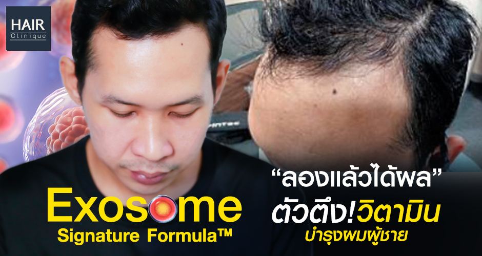 ลองแล้วได้ผล! Exosome Signature Formula™ ตัวตึงวิตามินบำรุงผมผู้ชาย