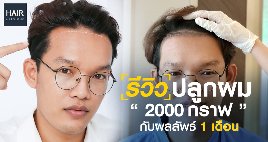 รีวิวปลูกผม 2000 กราฟ พร้อมผลลัพธ์หลังปลูกผม 1 เดือน