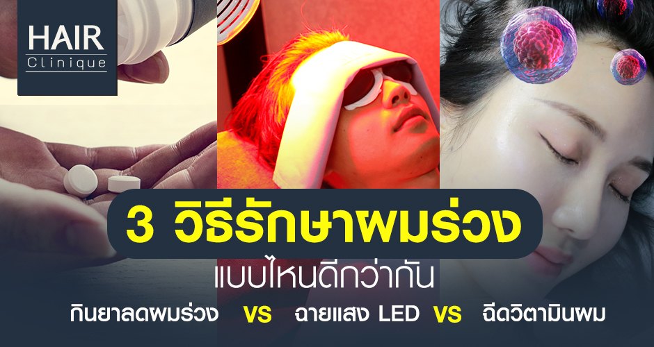 3 วิธีรักษาผมร่วง แบบไหนดีกว่ากัน กินยาลดผมร่วง vs ฉายแสง LED vs ฉีดวิตามินผม