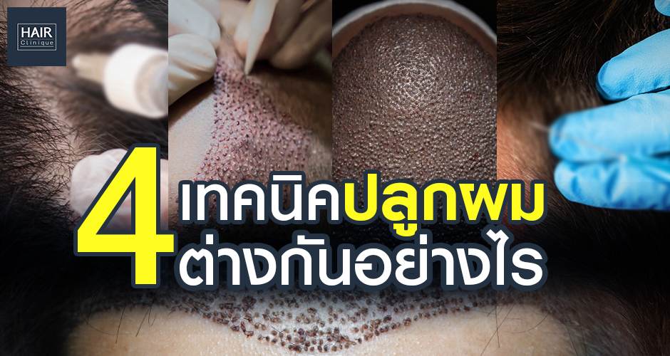 ปลูกผมที่ HairCliniquebySLC มีกี่แบบ ต่างกันอย่างไร