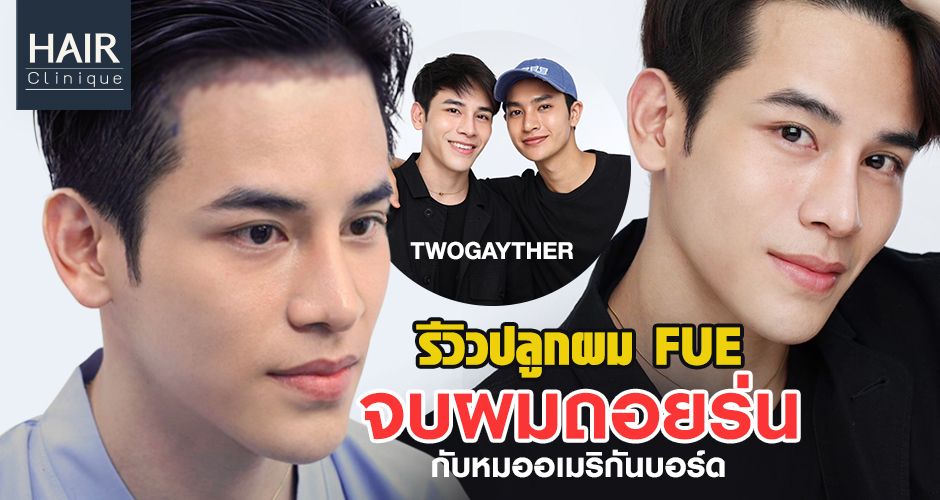 รีวิวปลูกผม FUE จบปัญหาผมถอยร่นกับหมอปลูกผม อเมริกันบอร์ด