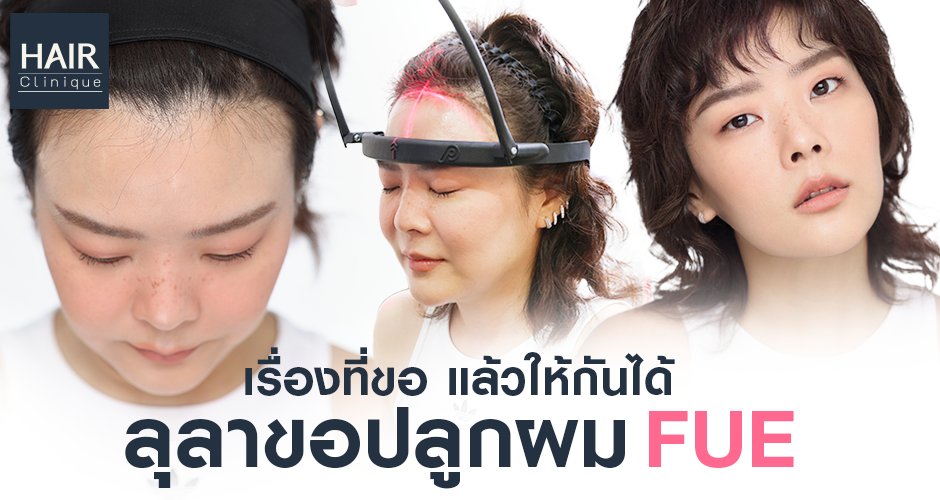 เรื่องที่ขอแล้วให้กันได้ ลุลาขอปลูกผม FUE