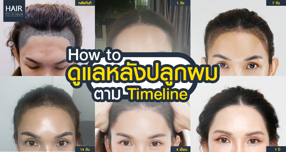 How to ดูแลหลังปลูกผมตาม Timeline