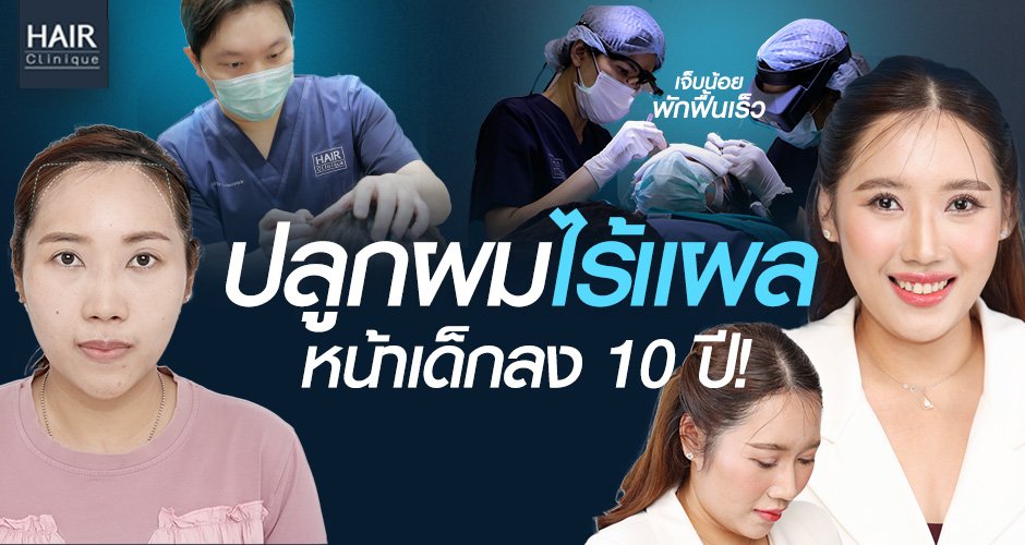 หน้าเด็ก ลดอายุ 10 ปี ด้วยการปลูกผมแบบไร้แผล เจ็บน้อย พักฟื้นเร็ว