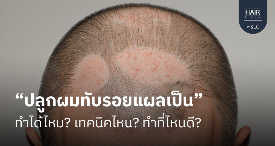 ปลูกผมทับรอยแผลเป็น ทำได้ไหม เทคนิคไหน ทำที่ไหนดี