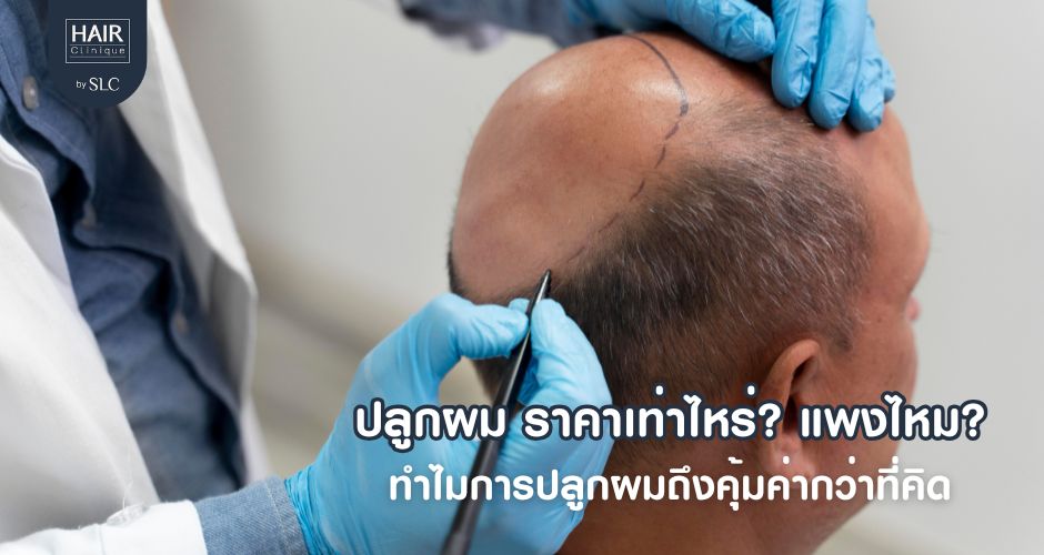 ปลูกผม ราคาเท่าไหร่? แพงไหม? ทำไมการปลูกผมถึงคุ้มค่ากว่าที่คิด
