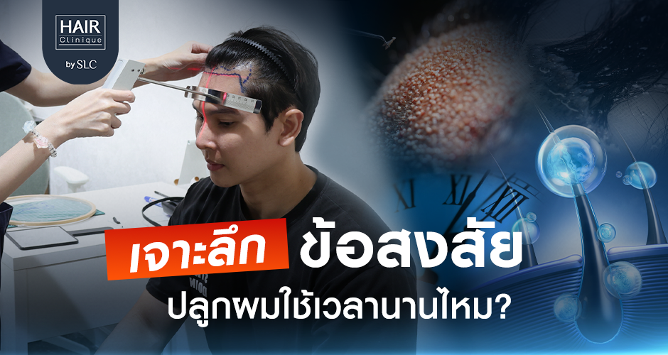 เจาะลึกข้อสงสัย ปลูกผมใช้เวลานานไหม?