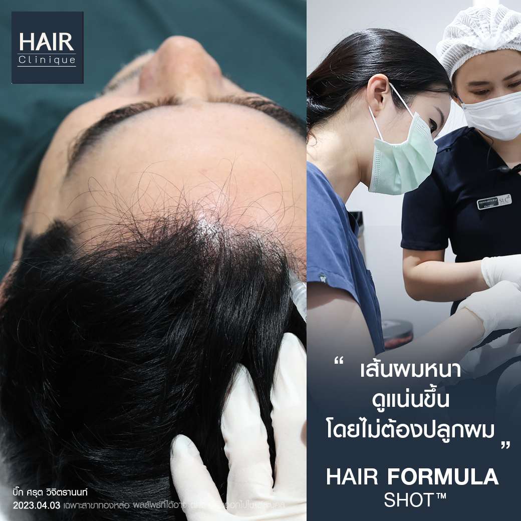 วิตามิน แก้ ผม ร่วง pantip,ผมร่วง,Hair fomula shot,วิธี หยุดผมร่วง,Hair formula shot™,Hair formula shot,ExosomeHair,หยุดผมร่วง,วิธีหยุดผมร่วง