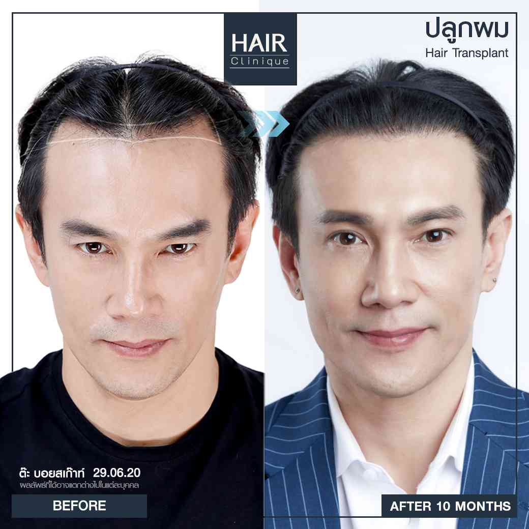 ปลูกผม,รีวิวปลูกผม,ปลูกผม fut,รีวิวปลูกผมfut,fut,hair transplant,รีวิวปลูกผมHairCliniquebySLC,รีวิวปลูกผมSLC