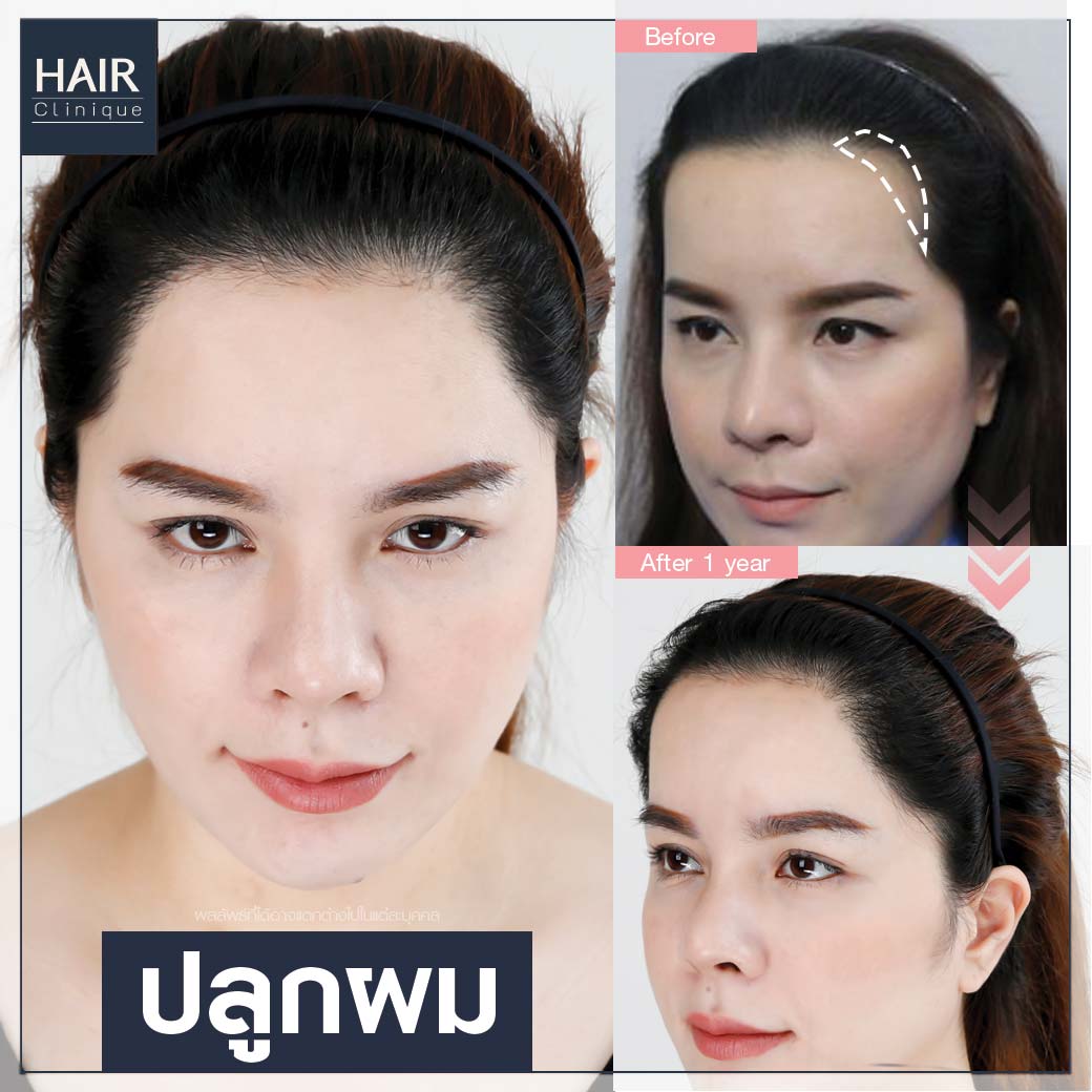 รีวิว ปลูกผม,ปลูกผม SLC,ปลูกผม Hair Clinique,รีวิวปลูกผม FUT,รีวิวปลูกผม FUE,ปลูกผมไม่เจ็บ,ปลูกผมที่ไหนดี