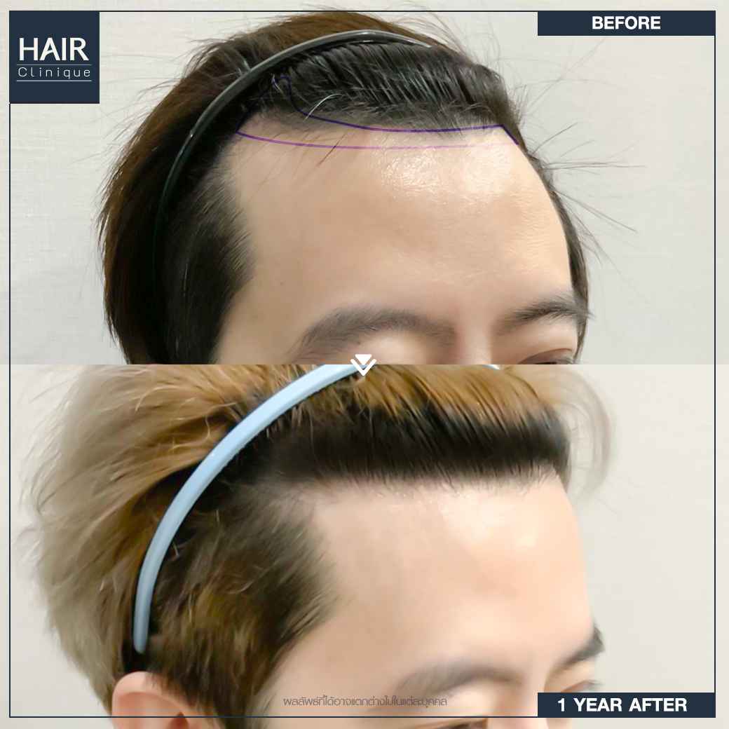 ปลูกผม,ปลูกผมที่ไหนดี,ปลูกผม hairclinique,รีวิวปลูกผม,ปลูกผมถาวร,รีวิวปลูกผม hairclinique