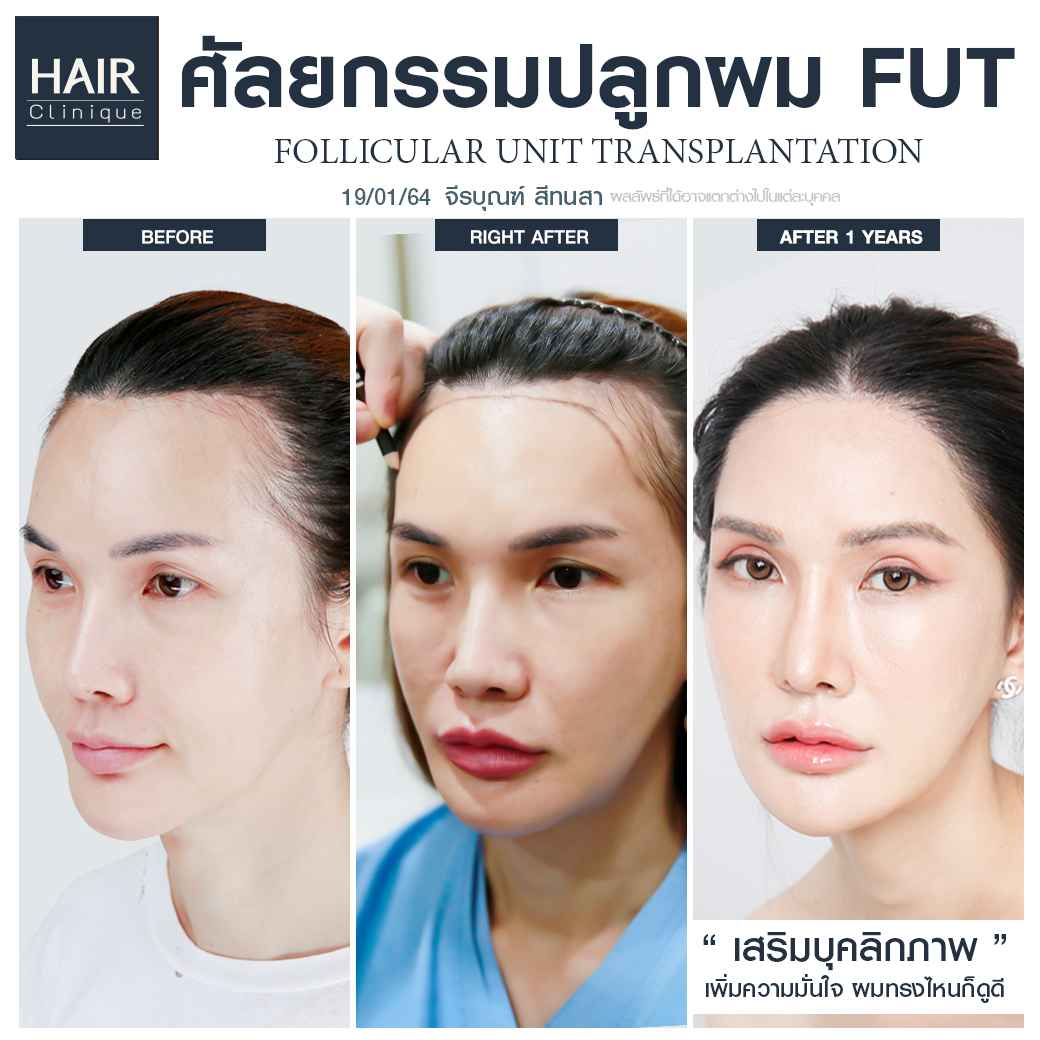 ปลูกผม,ปลูกผมที่ไหนดี,ปลูกผม hairclinique,รีวิวปลูกผม,ปลูกผมถาวร,รีวิวปลูกผม hairclinique