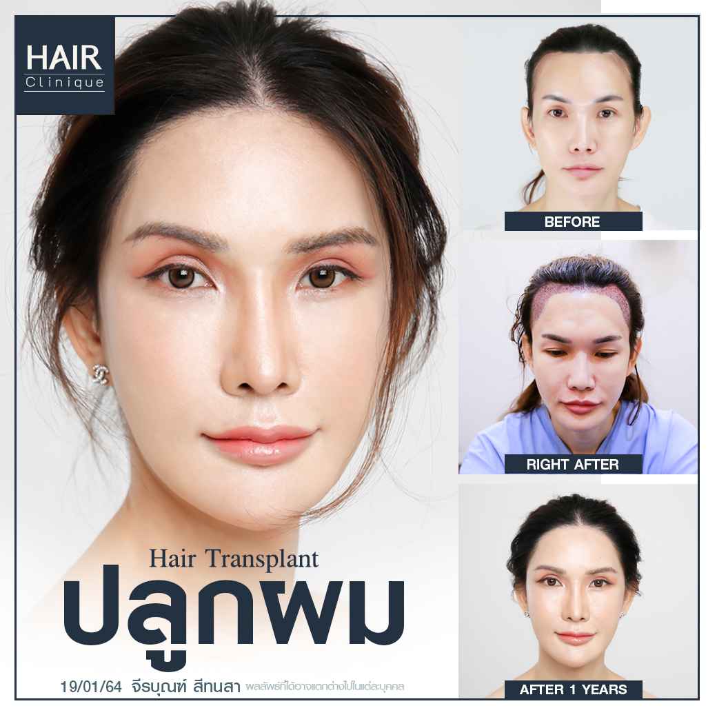 ปลูกผม,ปลูกผมที่ไหนดี,ปลูกผม hairclinique,รีวิวปลูกผม,ปลูกผมถาวร,รีวิวปลูกผม hairclinique