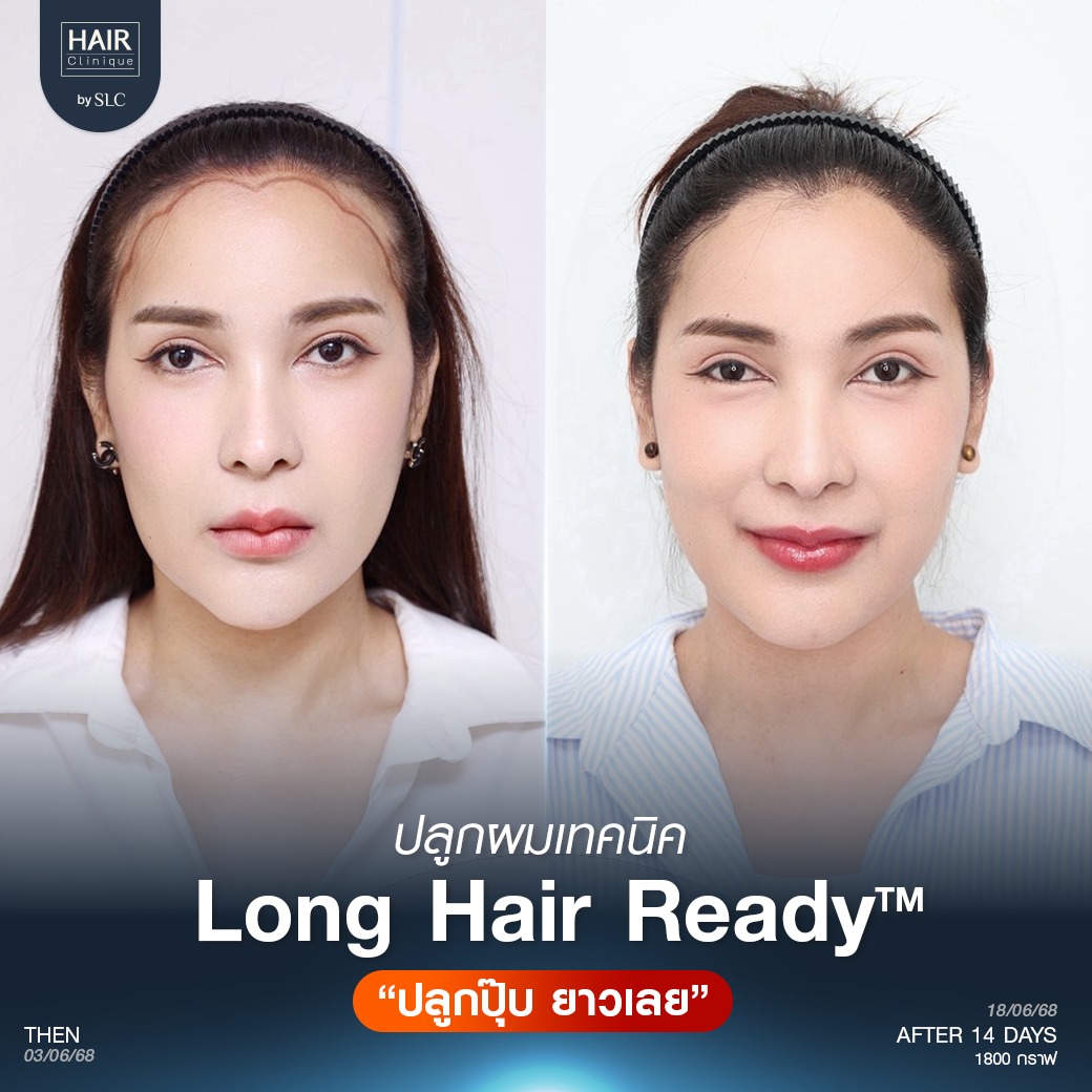 แนวไรผมดอกไม้