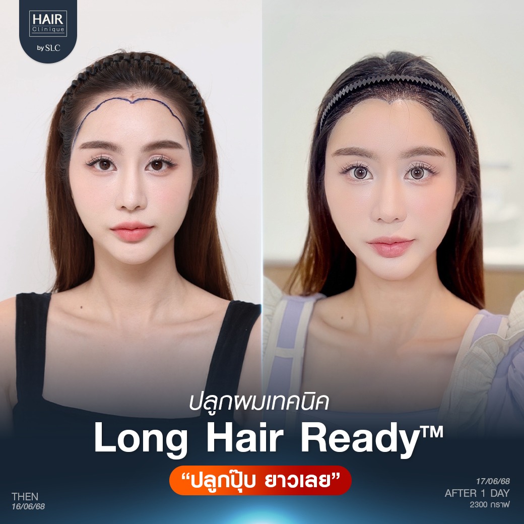 แนวไรผมดอกไม้