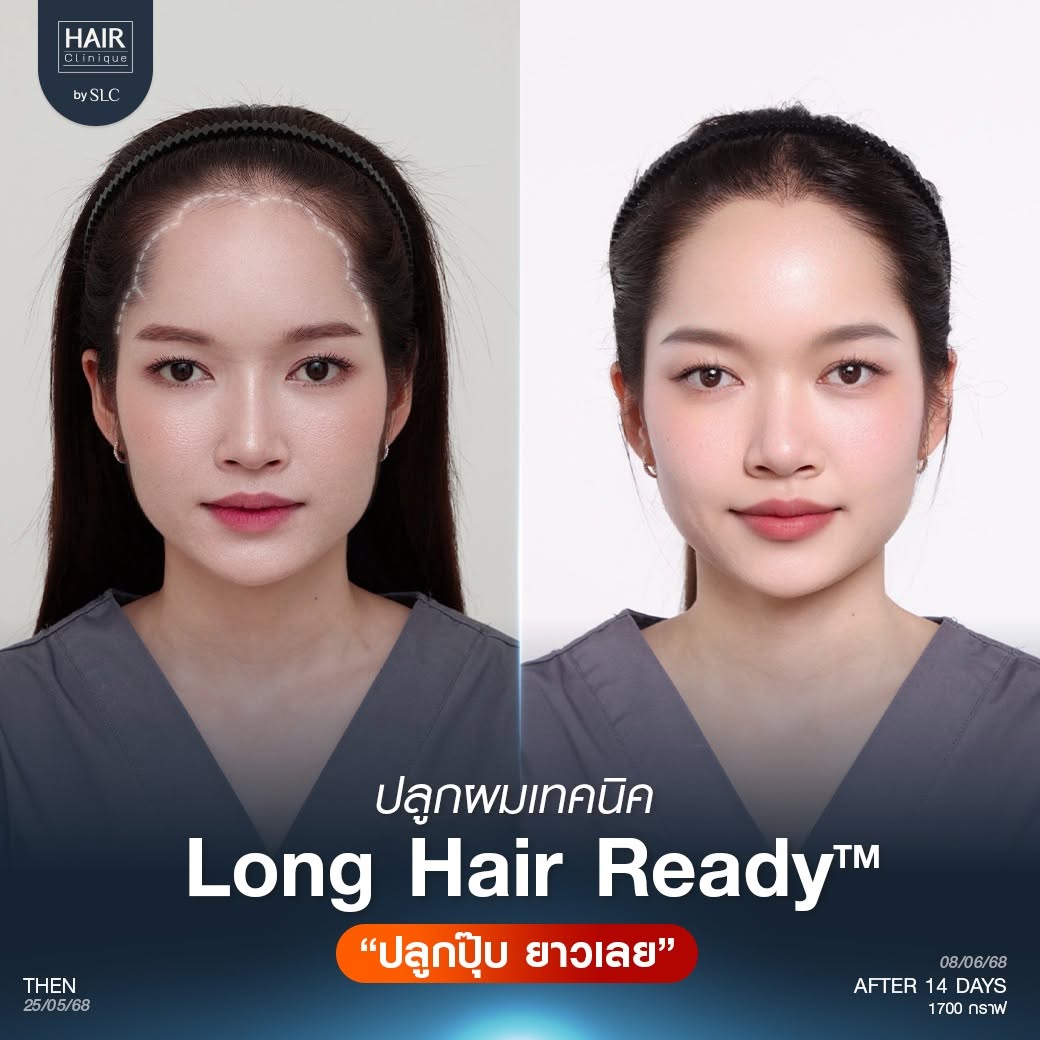 แนวไรผมดอกไม้