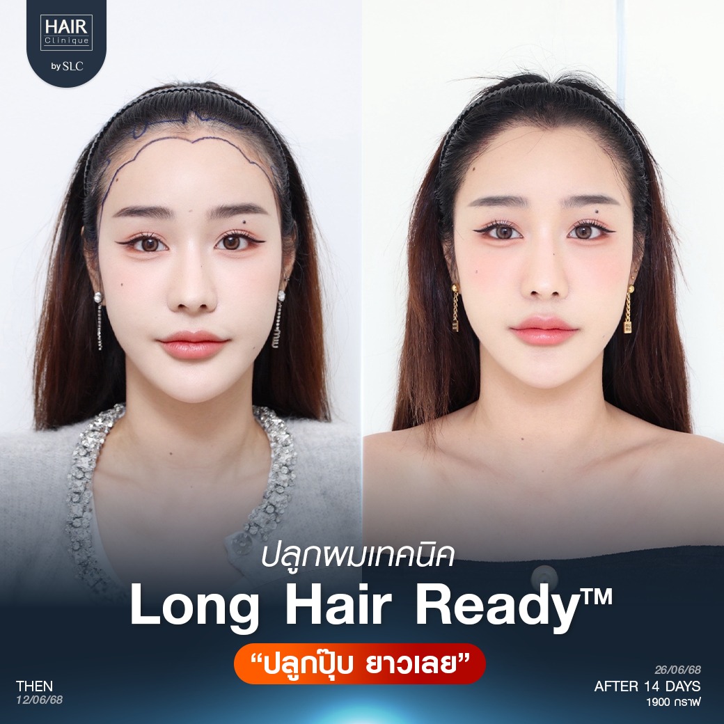 แนวไรผมดอกไม้