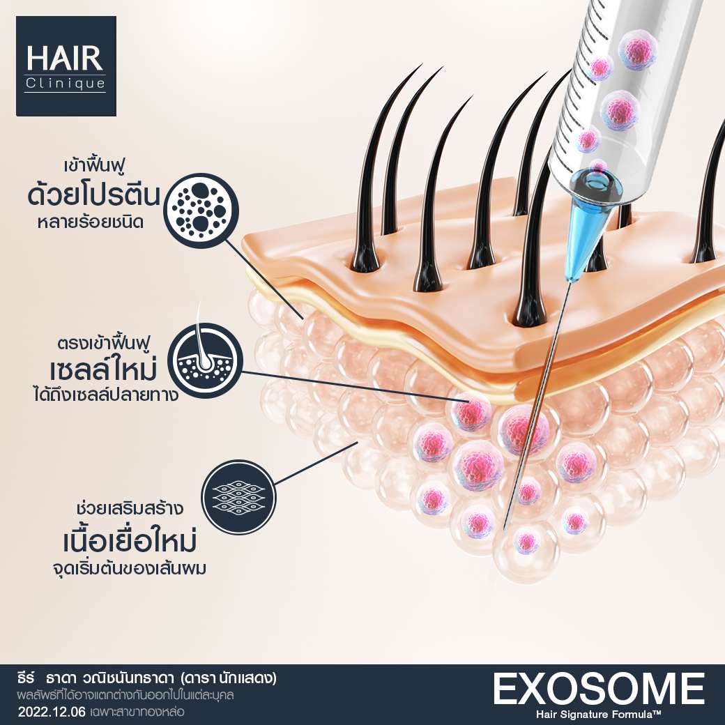 วิตามิน แก้ ผม ร่วง pantip,ผมร่วง,Hair fomula shot,วิธี หยุดผมร่วง,Hair formula shot™,Hair formula shot,ExosomeHair,หยุดผมร่วง,วิธีหยุดผมร่วง