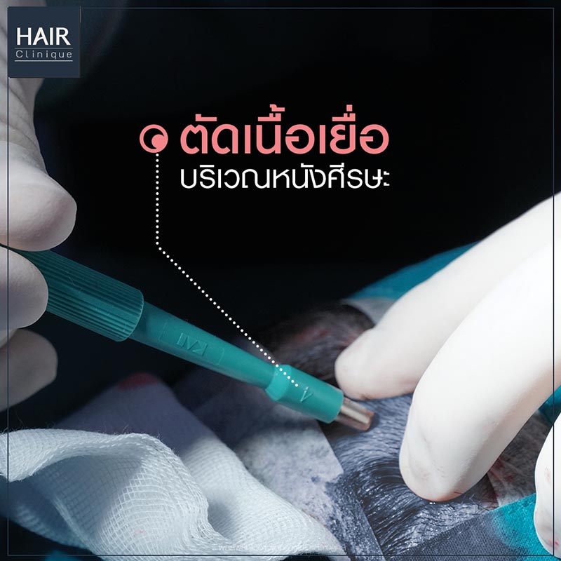 HairStemCell-ปลูกผมไม่ต้องผ่าตัด-ลดผมร่วง