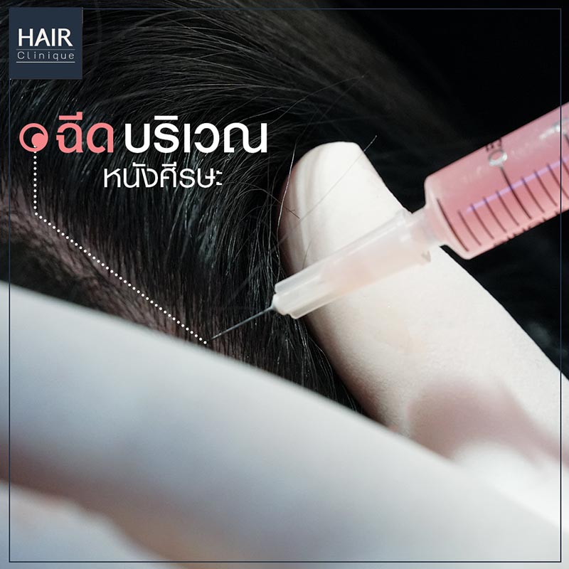 HairStemCell-ปลูกผมไม่ต้องผ่าตัด-ลดผมร่วง