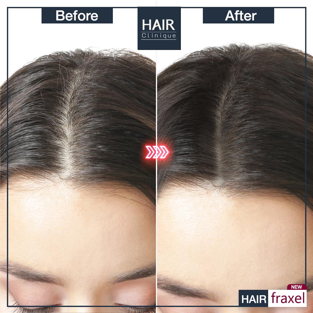 รีวิว Hair Fraxel เลเซอร์รักษาผมร่วง