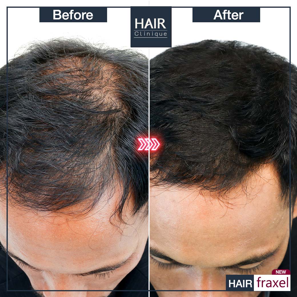 รีวิว Hair Fraxel เลเซอร์รักษาผมร่วง