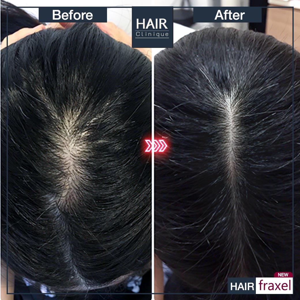 รีวิว Hair Fraxel เลเซอร์รักษาผมร่วง