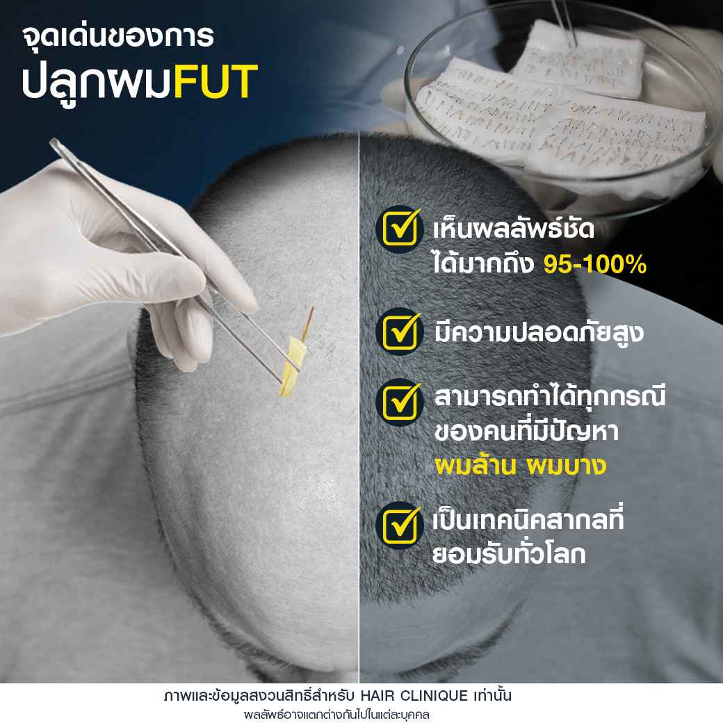 จุดเด่นของการปลูกผมfut,ปลูกผม FUT,Regenera activa,ปลูกผม,รีวิวปลูกผม,ผมบาง,หัวล้าน,หัวเถิก