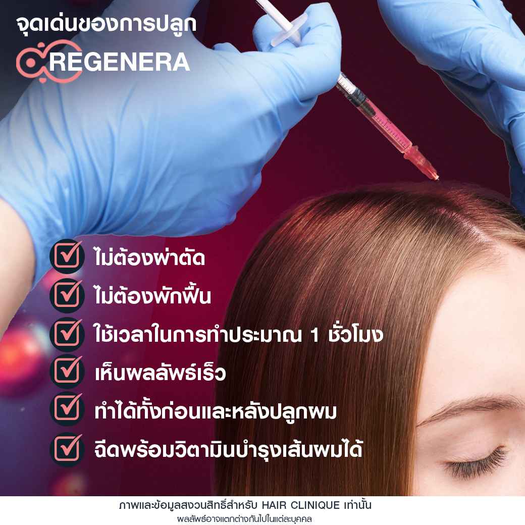 จุดเด่นของregenera activa,Regenera activa,ปลูกผม,รีวิวปลูกผม,ผมบาง,หัวล้าน,หัวเถิก